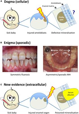 A Breakthrough in Understanding the Pathogenesis of Molar Hypomineralisation: The Mineralisation-Poisoning Model